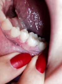 Красное пятно на десне болит зуб